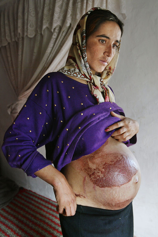 Herat, October 21, 2004. Twenty-year-old Mariam, who is nine months pregnant here, shows the scars that resulted from her suicide attempt three months earlier. Devastated by an abusive, violent marriage, she doused herself with household fuel and set it alight, subsequently spending twenty-eight days in the hospital. She now lives with her mother, and her husband is moving back in with her and her two-year-old daughter.