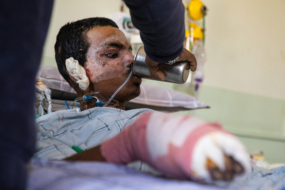 Chandan Ghosai, 20, a burn patient, is assisted by his dad, Ram, to take a sip of water at Burn Center in Kathmandu, Nepal. 